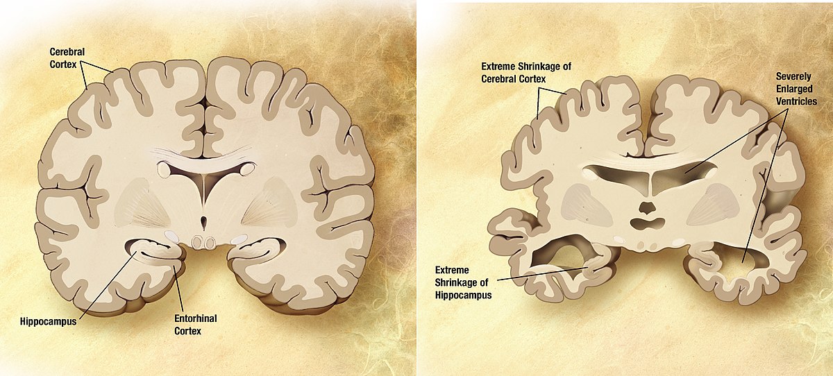 Alzheimer